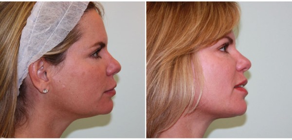 علاج Ulthera (Altera) في تجميل الأجهزة. قبل وبعد الصور والسعر والمراجعات