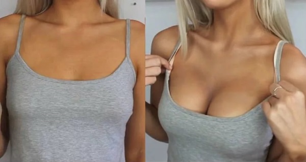 Pembedahan pembesaran payudara. Foto kanak-kanak perempuan dengan payudara besar, hasil, kemungkinan komplikasi