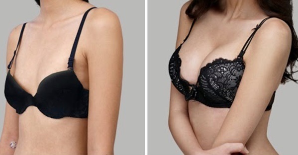 Pembedahan pembesaran payudara. Foto kanak-kanak perempuan dengan payudara besar, hasil, kemungkinan komplikasi