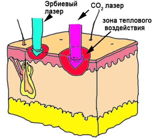 Laser Erbium trong thẩm mỹ. Hình ảnh trước và sau, kết quả ứng dụng, đánh giá