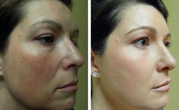 Laser Erbium trong thẩm mỹ. Hình ảnh trước và sau, kết quả ứng dụng, đánh giá