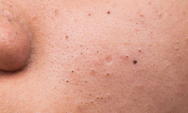 جل لتنظيف الوجه بالموجات فوق الصوتية. أيهما أفضل أو كيف يحل محل الاستعراضات