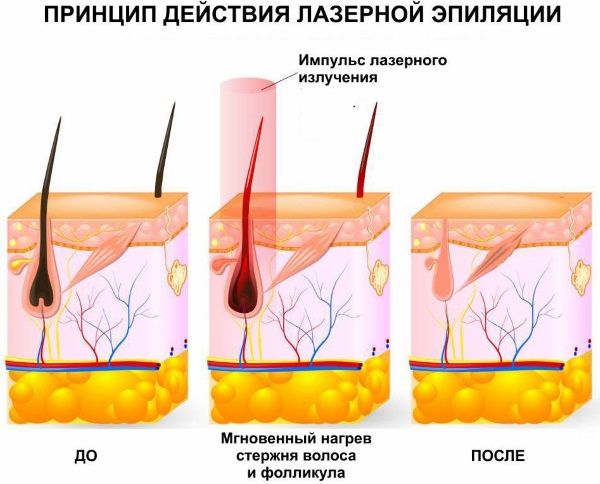 Ласер за лице у козметологији. Врсте, фотографије пре и после пријаве, прегледи