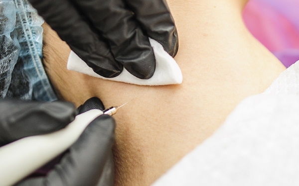 Loại bỏ u nhú trên mặt bằng phương pháp laser, nitơ, sóng vô tuyến, thuốc mỡ từ hiệu thuốc, biện pháp dân gian