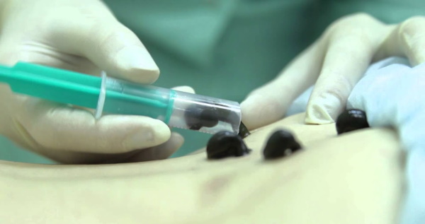 العلاج بالهرمونات في التجميل لعلاج الدوالي والسيلوليت وعلامات التمدد. التدريب ، قبل وبعد الصور والتعليقات