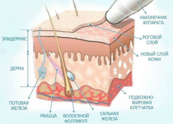 Tái tạo bề mặt kim cương (làm sạch) khuôn mặt. Nhận xét, hình ảnh trước và sau khi bóc
