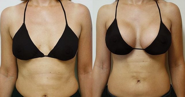 Adakah seorang gadis cantik dengan payudara besar? Sekiranya saya menjadikan payudara lebih besar, kebaikan dan keburukan