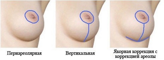 Adakah seorang gadis cantik dengan payudara besar? Sekiranya saya menjadikan payudara lebih besar, kebaikan dan keburukan
