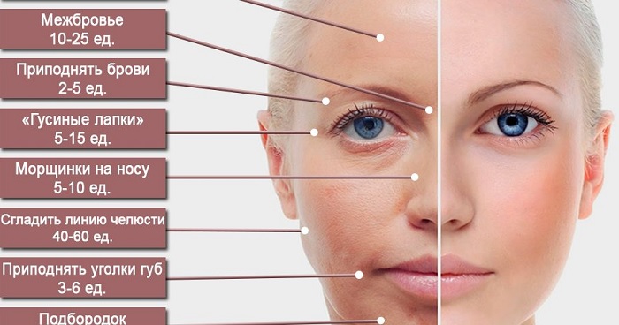 Botulax (Botulax): đánh giá của các chuyên gia thẩm mỹ, giá cả, hướng dẫn sử dụng