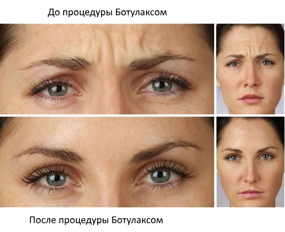 Botulax (Botulax): đánh giá của các chuyên gia thẩm mỹ, giá cả, hướng dẫn sử dụng