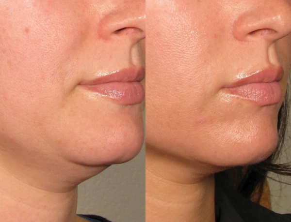 Dermaheal LL (Dermahil LL) phân giải mỡ. Đánh giá, giá cả, hình ảnh trước và sau