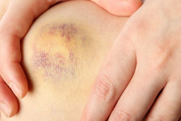 Dermaheal LL (Dermahil LL) phân giải mỡ. Đánh giá, giá cả, hình ảnh trước và sau