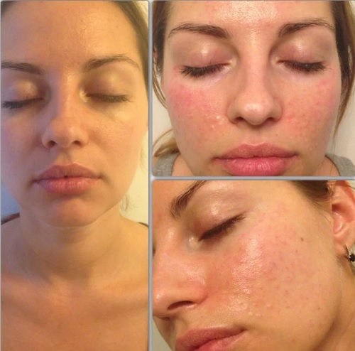 Huaron (ไฮรอน) biorevitalizant บทวิจารณ์คำอธิบายราคา