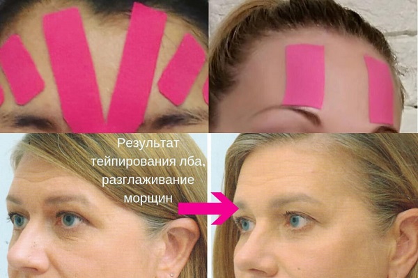 Gravação de rugas de sobrancelha. Esquema, foto antes e depois