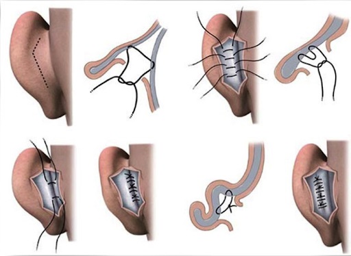 Những cô gái xinh đẹp 16-17-18 tuổi trước và sau khi phẫu thuật thẩm mỹ. Một bức ảnh