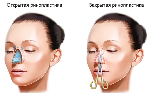 Những cô gái xinh đẹp 16-17-18 tuổi trước và sau khi phẫu thuật thẩm mỹ. Một bức ảnh