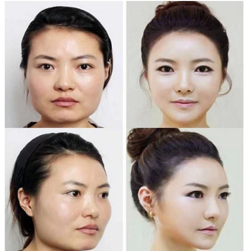 Những cô gái xinh đẹp 16-17-18 tuổi trước và sau khi phẫu thuật thẩm mỹ. Một bức ảnh