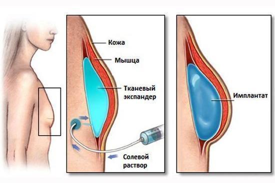 Phẫu thuật thẩm mỹ ngực ở đâu. Giá, đánh giá, ảnh trước và sau