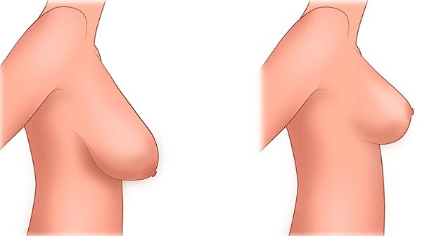Phẫu thuật thẩm mỹ ngực ở đâu. Giá, đánh giá, ảnh trước và sau