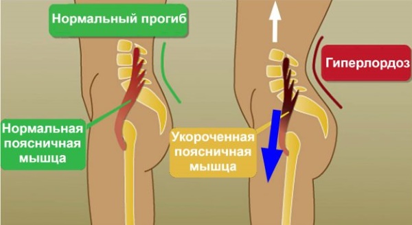 Otot iliopsoas. Latihan pengukuhan, regangan, cara mengepam