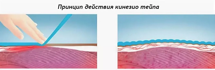Gravação de rugas de sobrancelha. Esquema, foto antes e depois
