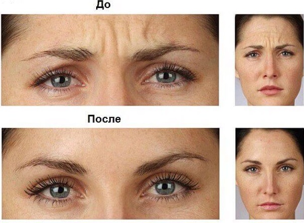 Gravação de rugas de sobrancelha. Esquema, foto antes e depois