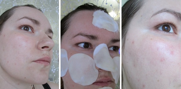 Làm thế nào để thoát khỏi bài mụn trứng cá tại nhà. Phương tiện, kem, badyaga, lột da, sửa sẹo, thuốc mỡ