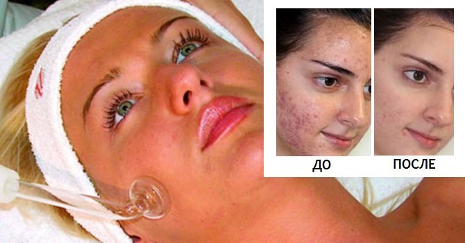 Làm thế nào để thoát khỏi bài mụn trứng cá tại nhà. Phương tiện, kem, badyaga, lột da, sửa sẹo, thuốc mỡ