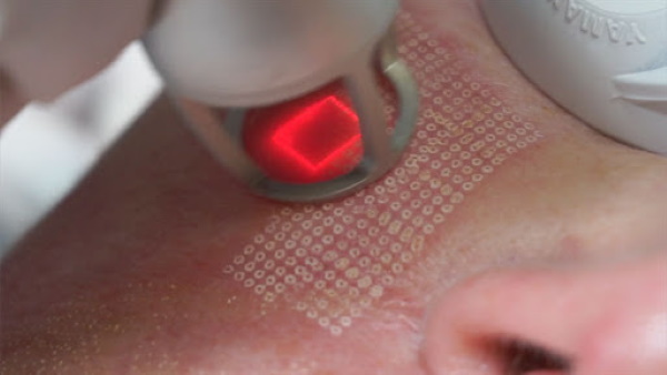 Laser mengembalikan permukaan kelopak mata (pseudoblepharoplasty). Harga, cara melakukannya, sebelum dan selepas gambar