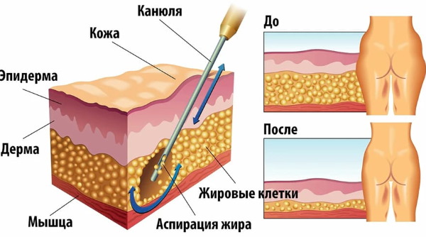 Liposuction paha, kaki tebal pada wanita. Sebelum dan selepas gambar, harga, ulasan