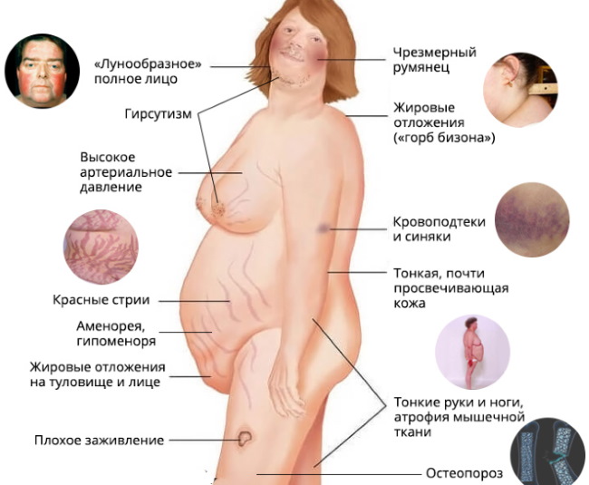 Liposuction paha, kaki tebal pada wanita. Sebelum dan selepas gambar, harga, ulasan
