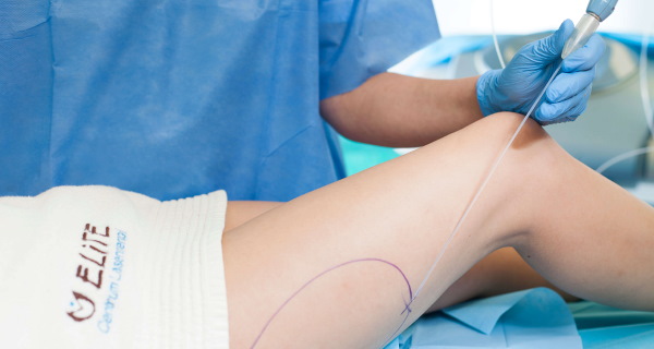 Liposuction paha, kaki tebal pada wanita. Sebelum dan selepas gambar, harga, ulasan