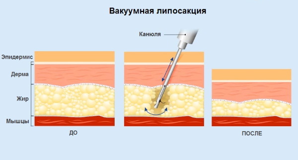 Liposuction paha, kaki tebal pada wanita. Sebelum dan selepas gambar, harga, ulasan