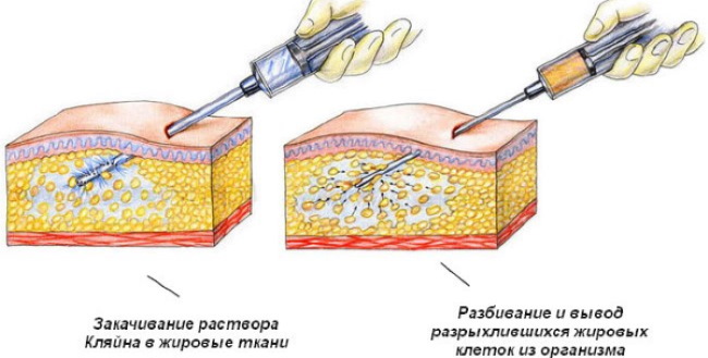 Liposuction paha, kaki tebal pada wanita. Sebelum dan selepas gambar, harga, ulasan