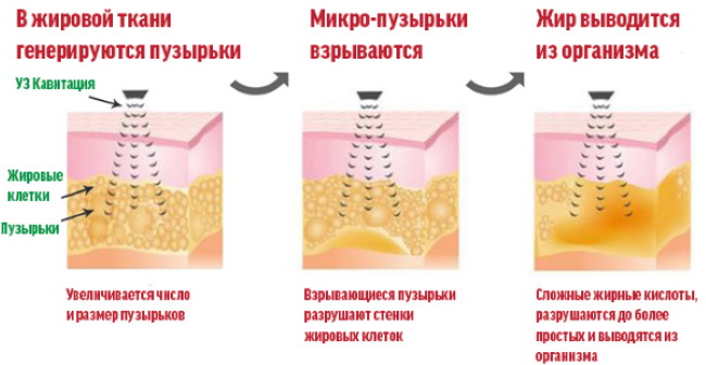 Liposuction paha, kaki tebal pada wanita. Sebelum dan selepas gambar, harga, ulasan