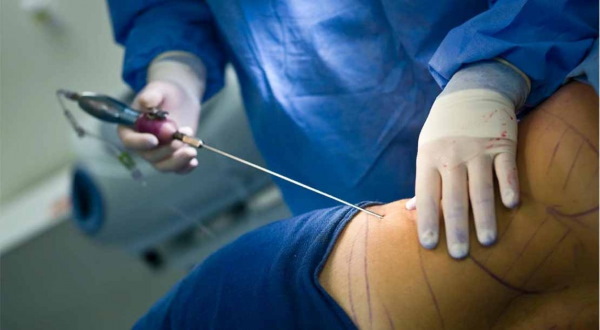 Liposuction paha, kaki tebal pada wanita. Sebelum dan selepas gambar, harga, ulasan
