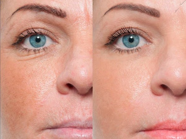 Meso ais (Mesoeye C71) untuk mata. Foto sebelum dan selepas, ulasan, harga