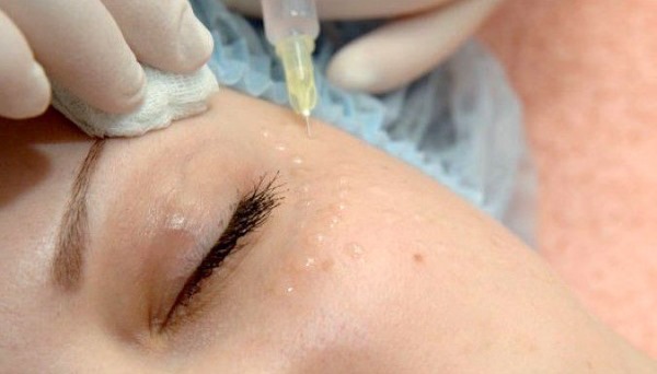 Meso ais (Mesoeye C71) untuk mata. Foto sebelum dan selepas, ulasan, harga