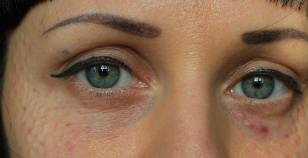 Meso ais (Mesoeye C71) untuk mata. Foto sebelum dan selepas, ulasan, harga
