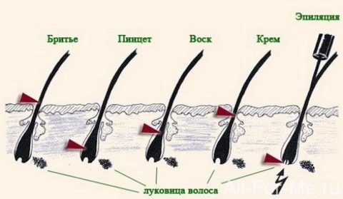 Како уклонити длаке на лицу, грудима, ногама, телу, интимним местима. Најефикаснији начини