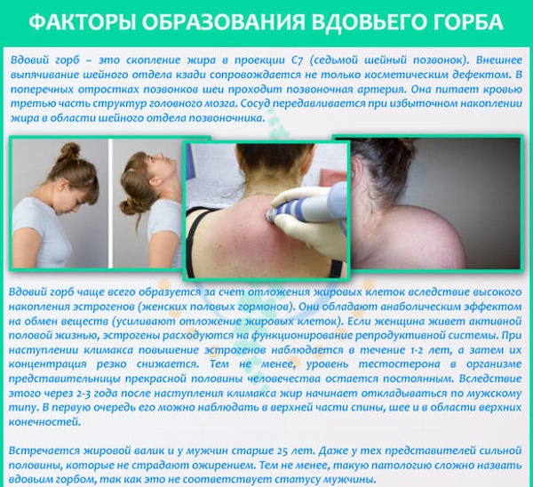 แบบฝึกหัดเพื่อเอาโคกของแม่ม่าย วิดีโอโดย Bubnovsky, Kurkurina, Shishonin