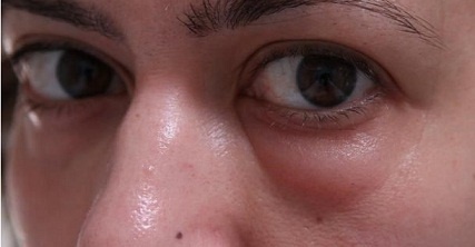 Botox sob os olhos. Antes e depois das fotos, efeitos, avaliações, consequências