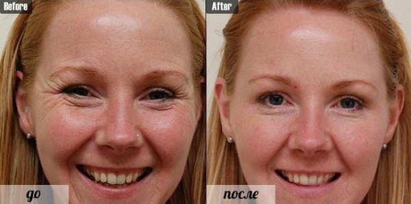 Botox sob os olhos. Antes e depois das fotos, efeitos, avaliações, consequências