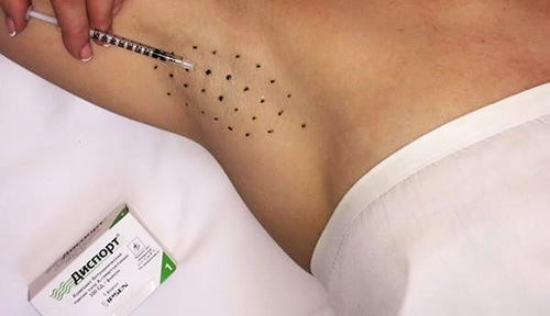 Ketiak botox. Ulasan, kesan sampingan, harga