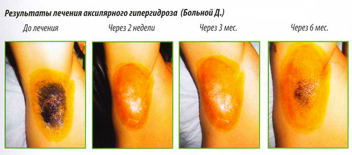 Ketiak botox. Ulasan, kesan sampingan, harga