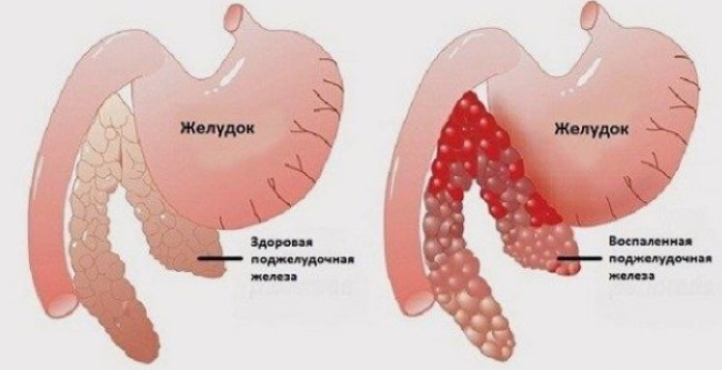 Липолитици за двоструку браду. Цена, фотографија, прегледи