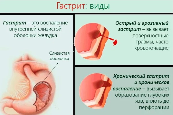 Никотин (никотинска киселина) у ињекцијама. Упутства, индикације за употребу, ток лечења