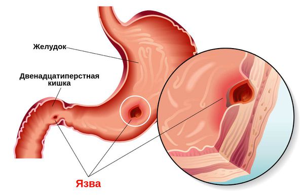 Никотин (никотинска киселина) у ињекцијама. Упутства, индикације за употребу, ток лечења
