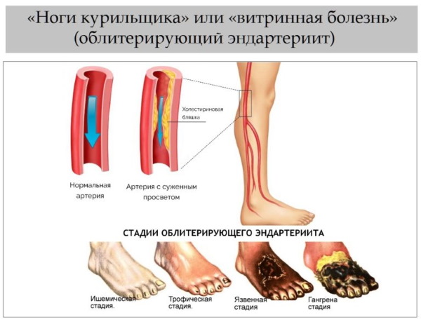Никотин (никотинска киселина) у ињекцијама. Упутства, индикације за употребу, ток лечења