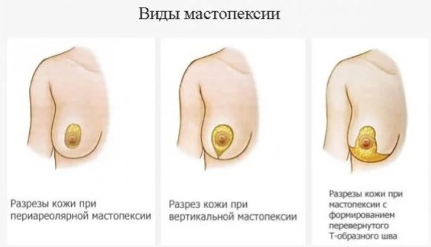 Цевасти облик млечних жлезда, дојке. Фотографија, корекција без операције за жене, мушкарце